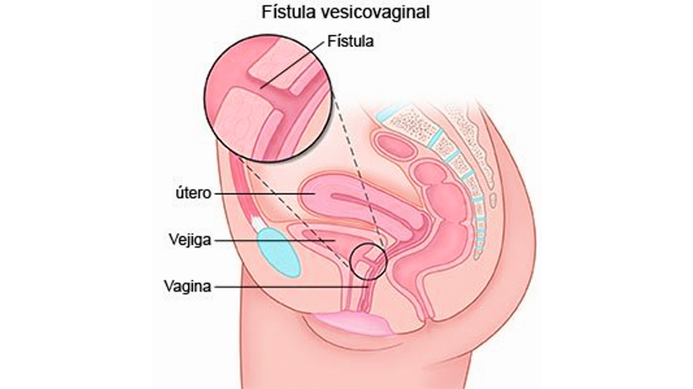 Reparación de fístula vesicovaginal
