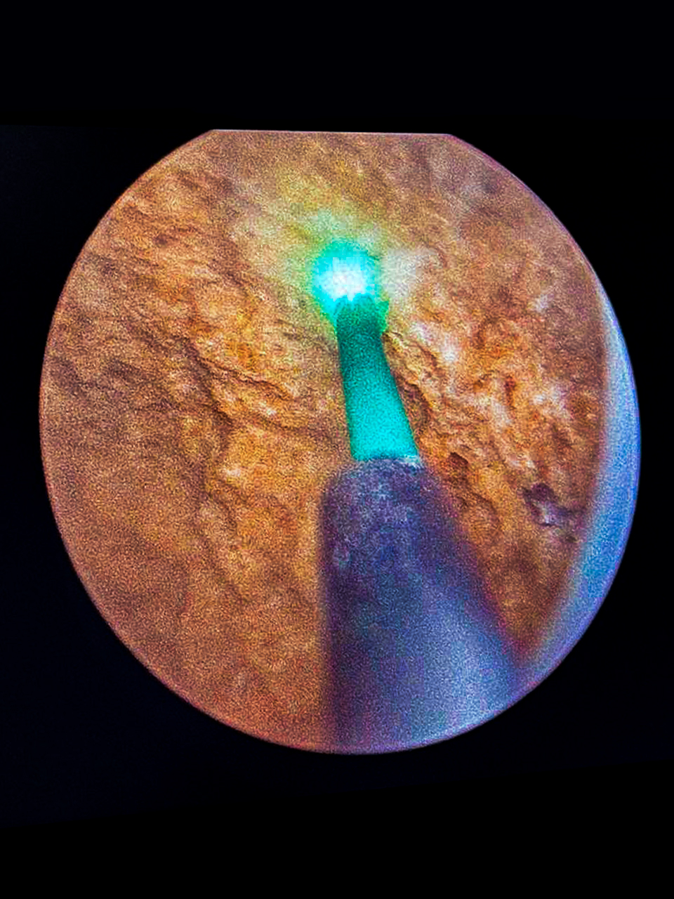 Litiasis renal y ureteral con láser