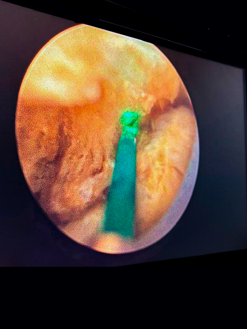 Litiasis renal