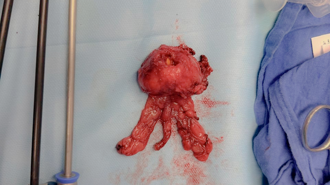 Prostatectomía radical laparoscópica
