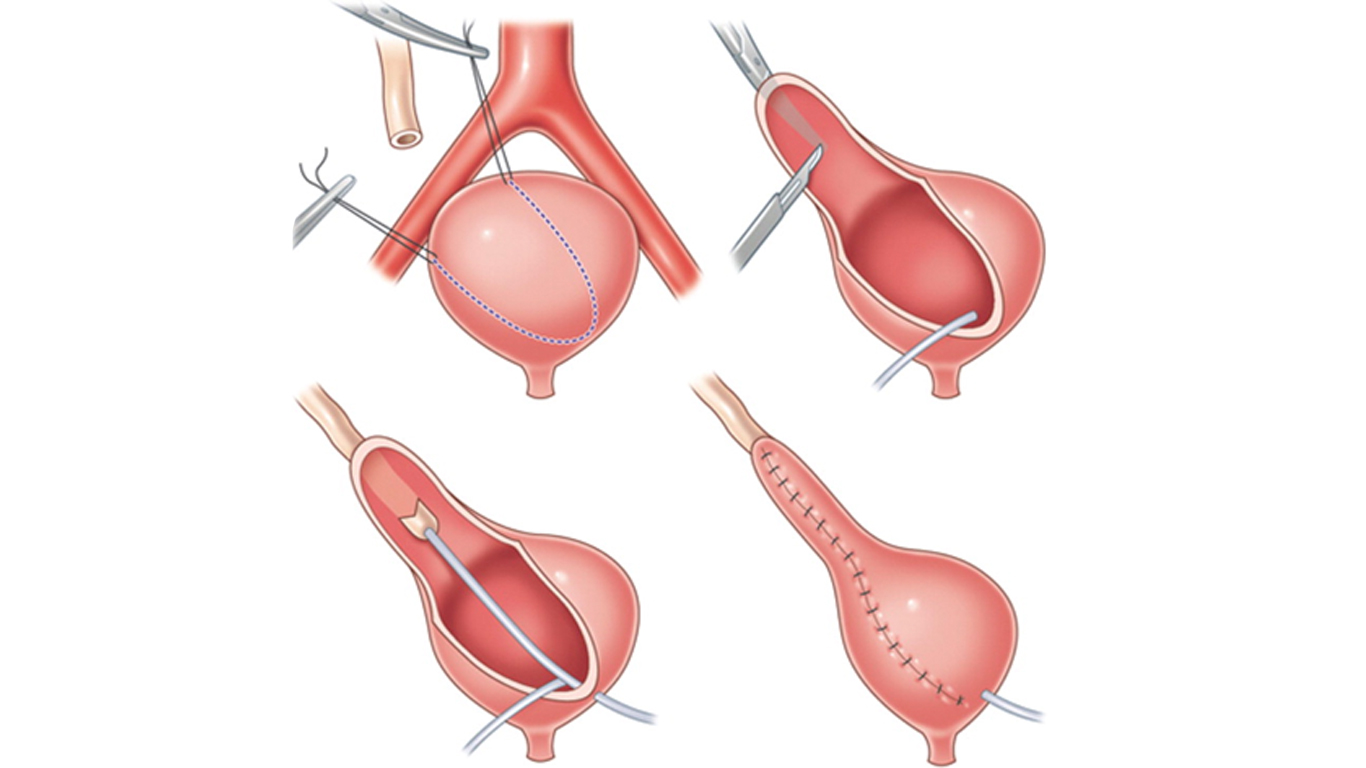 Reimplante ureteral laparoscópico